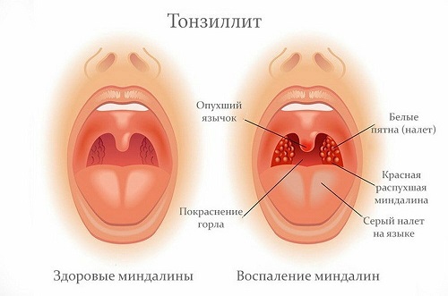 Лечение тонзиллита у детей и взрослых